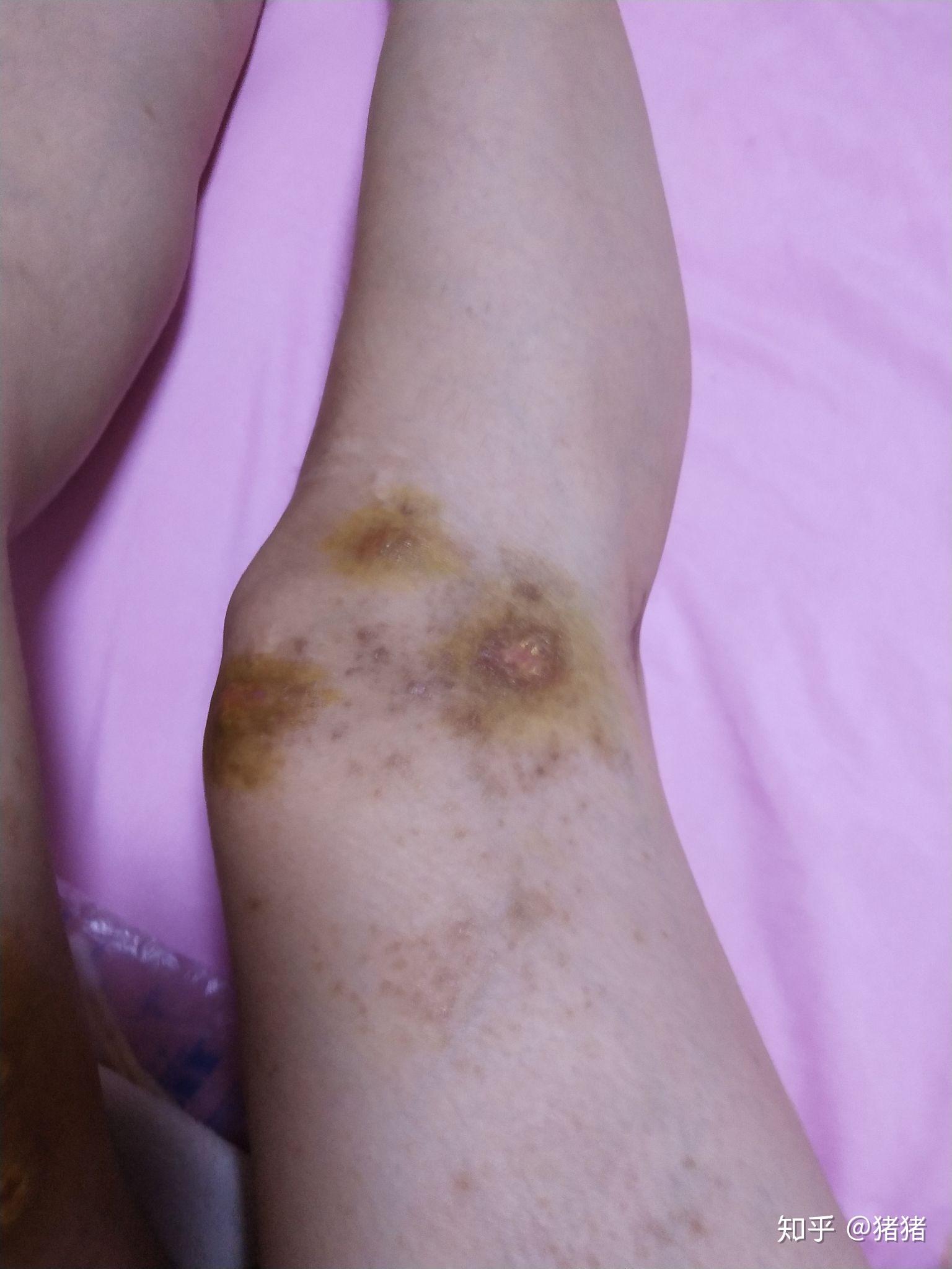 被海蜇蛰伤已经4个多月了,这几天又复发了有经验的探讨一下怎么才能好