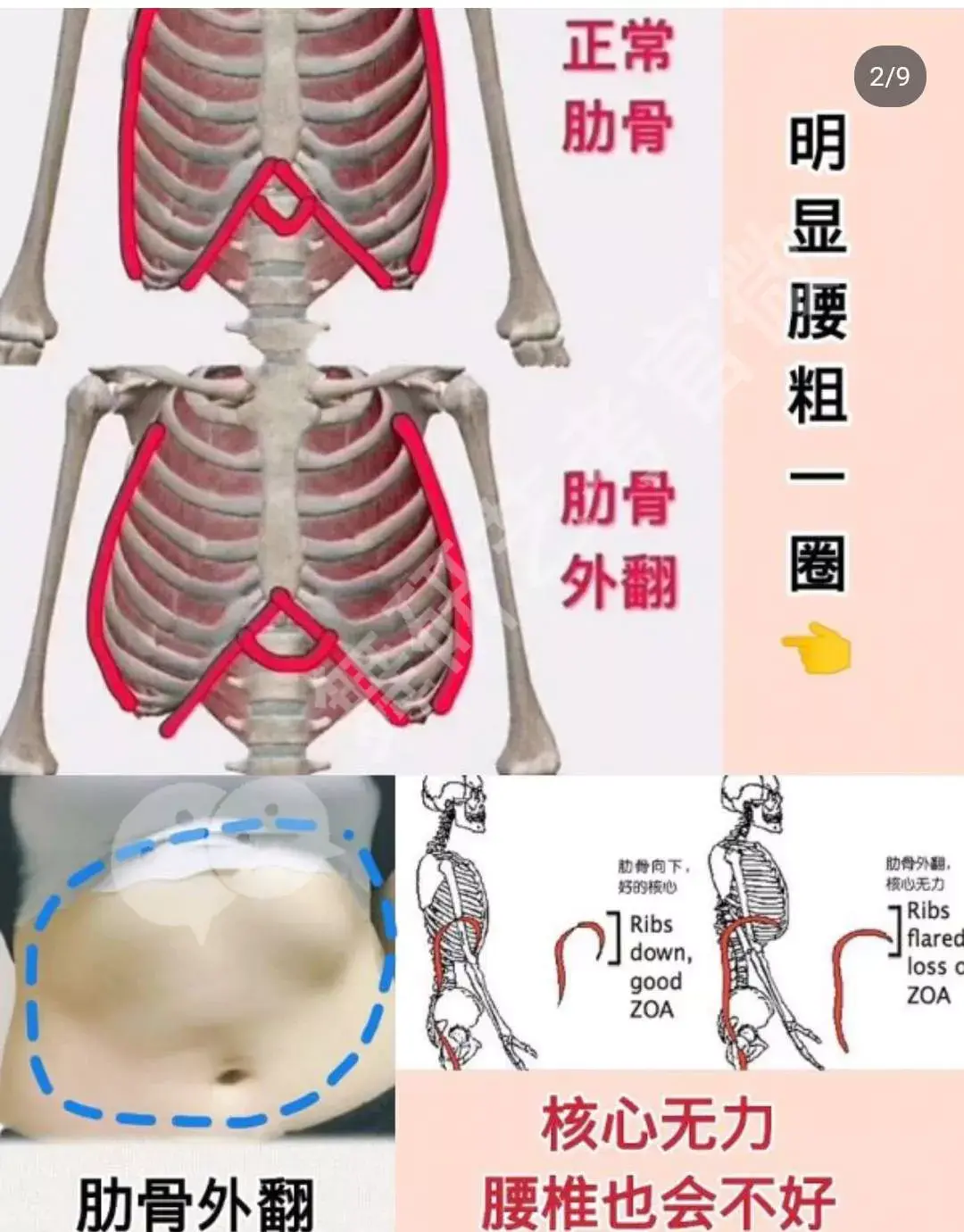 肋骨外翻的4种常见形成原因与处理方法