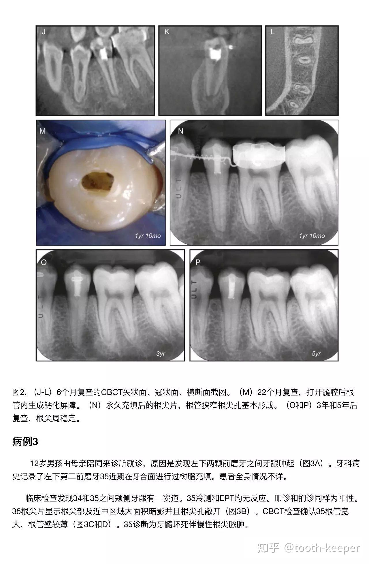 活髓切断治疗年轻恒牙根尖周炎一例