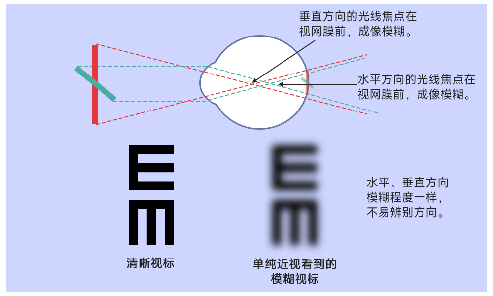 8的孩子,为何却有高度散光?