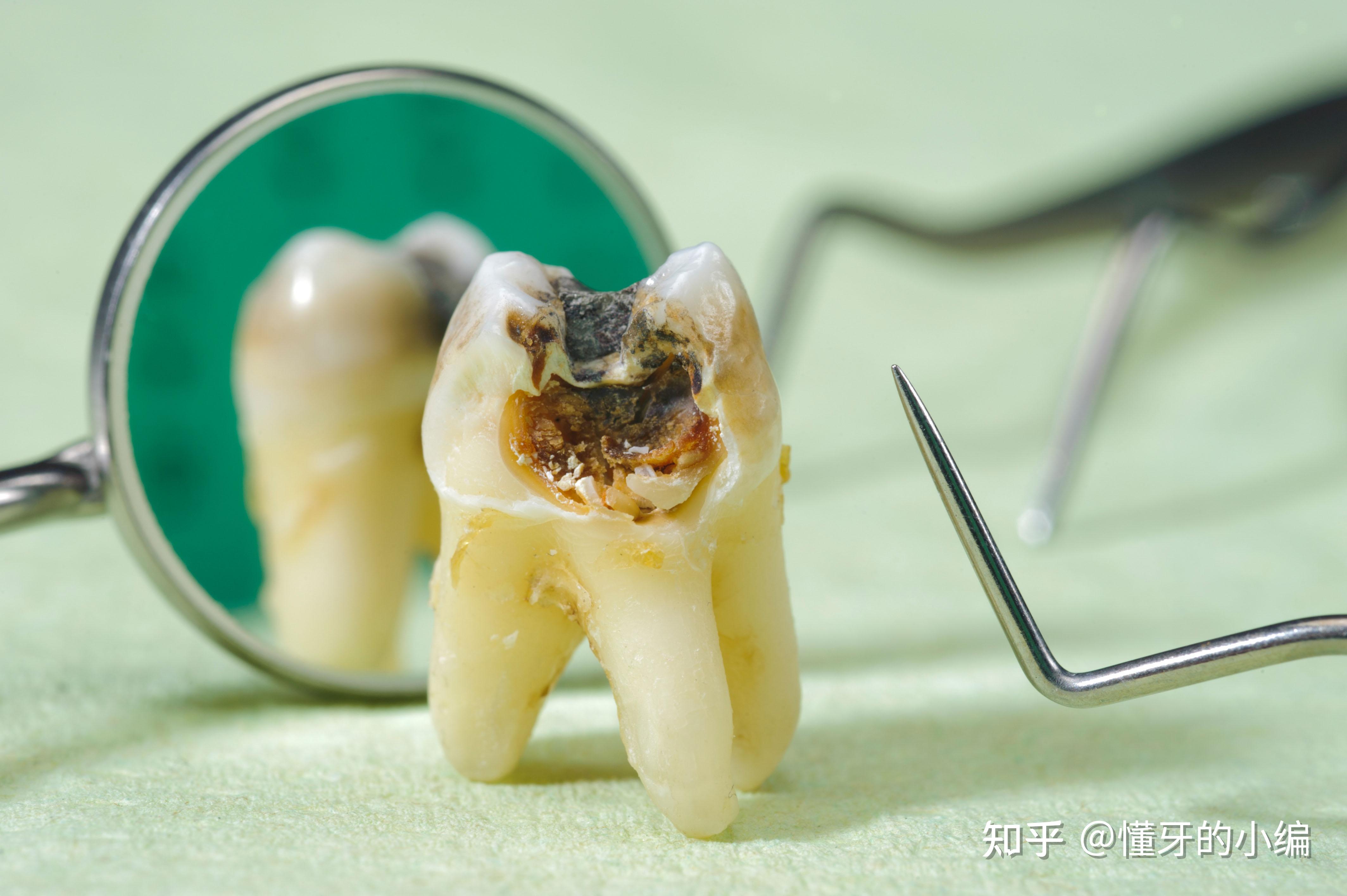 Próchnica zębów mlecznych: przyczyny, objawy, leczenie próchnicy u dwu ...