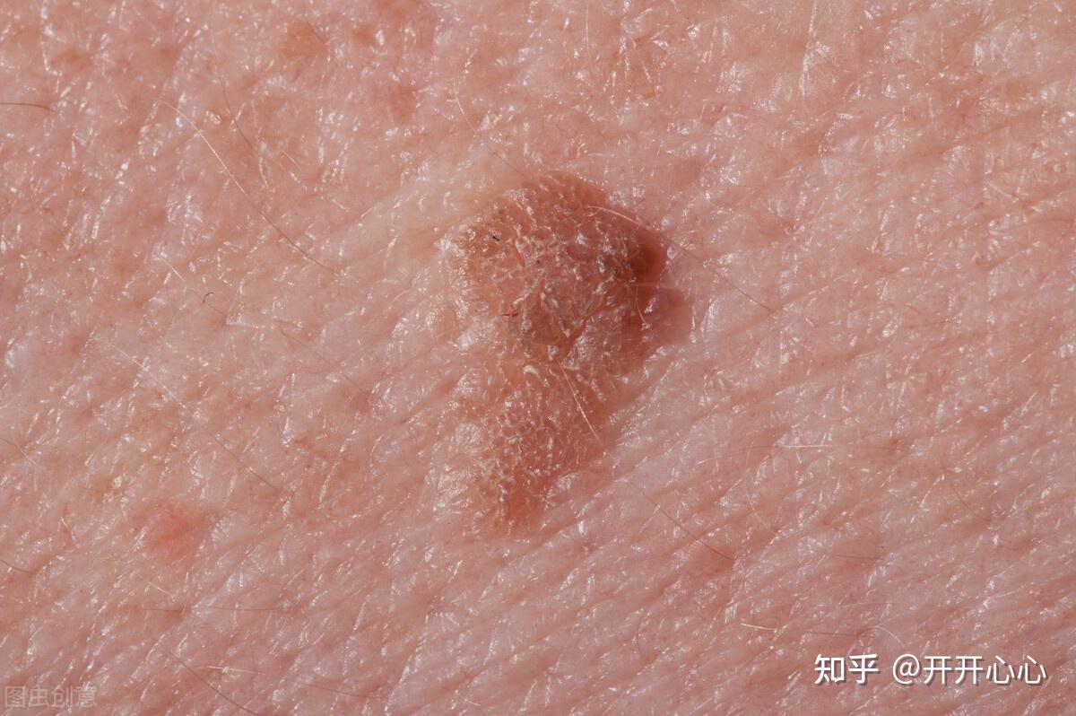 女人若双腿有3种变化未必是风湿劝你早查hpv