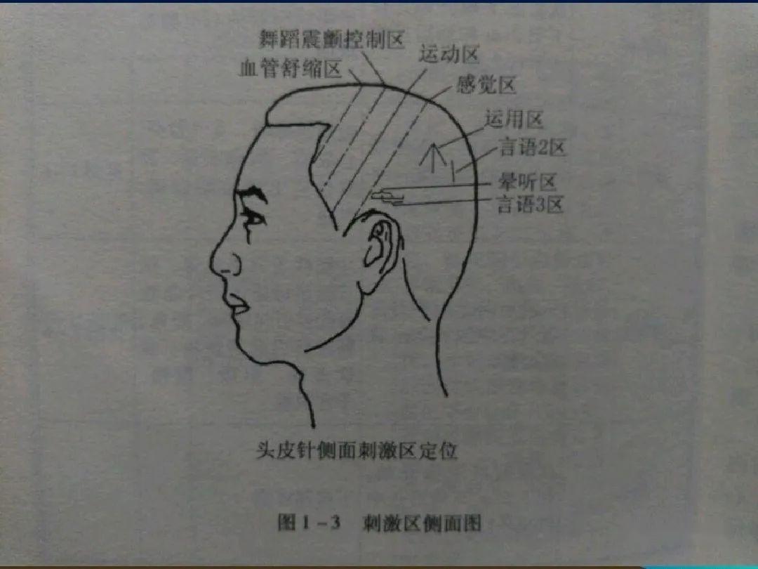 头针语言区定位图片