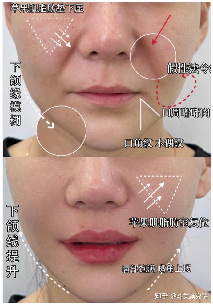 玻尿酸丰唇效果怎么样? 嘴巴薄、不对称、下垂的唇部基础可以做吗?价格怎么样? - 知乎