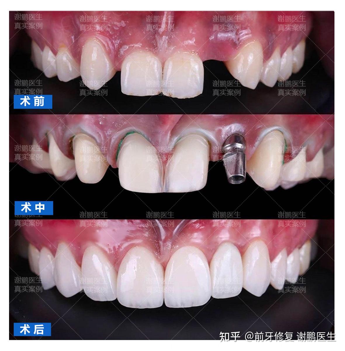 種植牙治療的週期有多長成功率如何