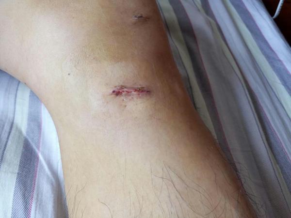 前十字韧带康复历程