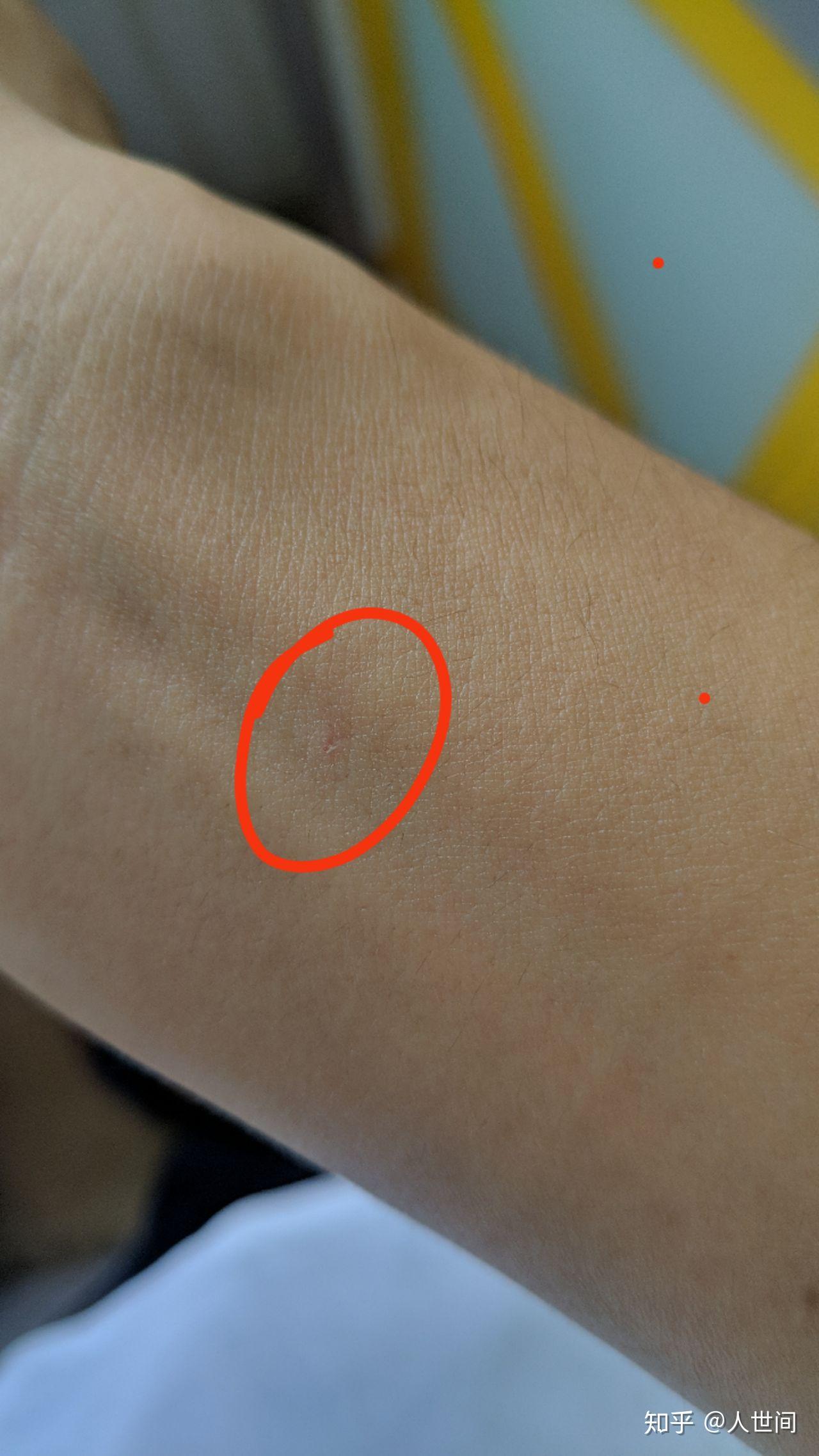 被朋友的宠物猫抓伤了像打吊针时那样肿了一些朋友说他的猫打过针的我