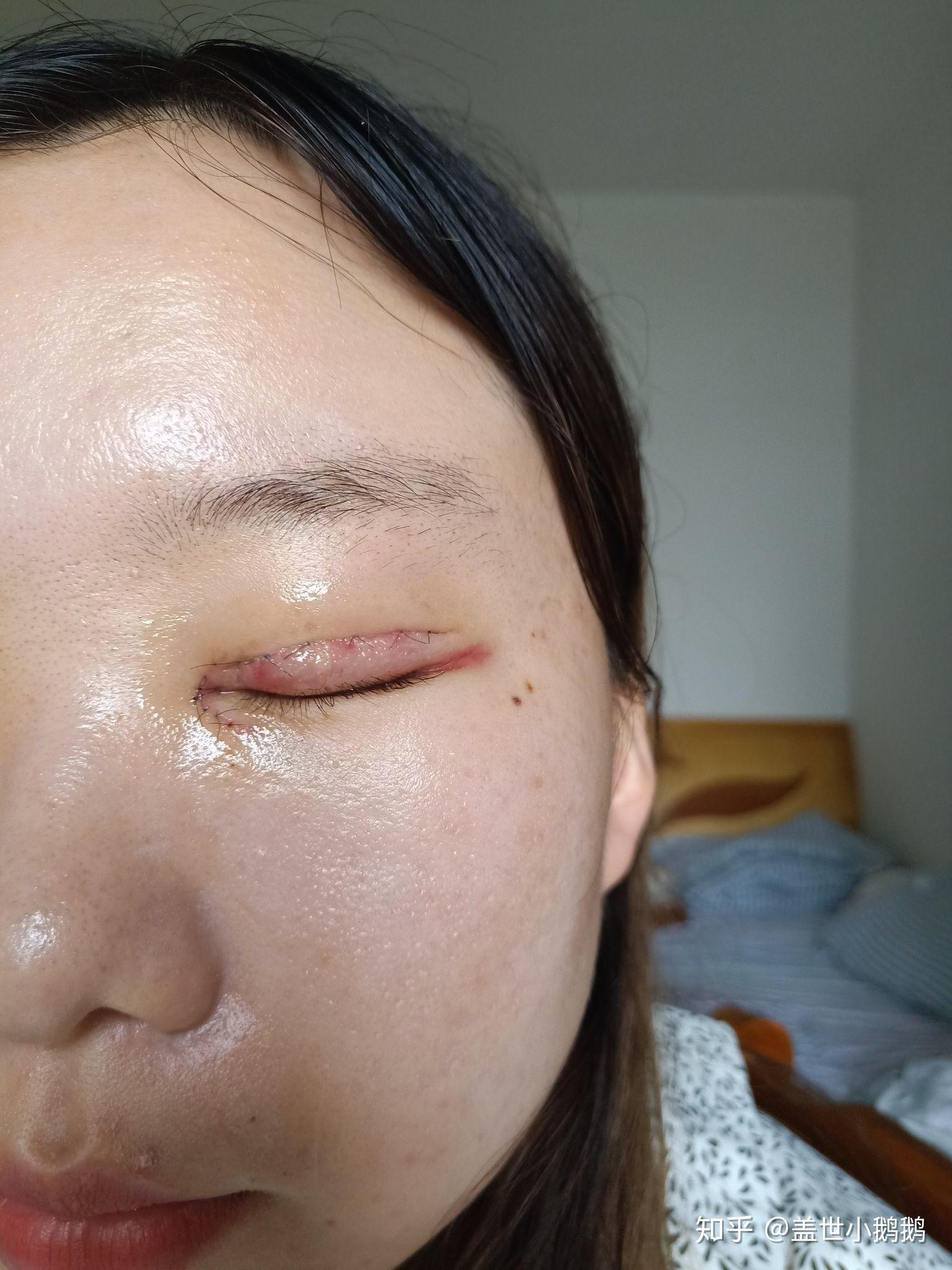 全切双眼皮加开眼角