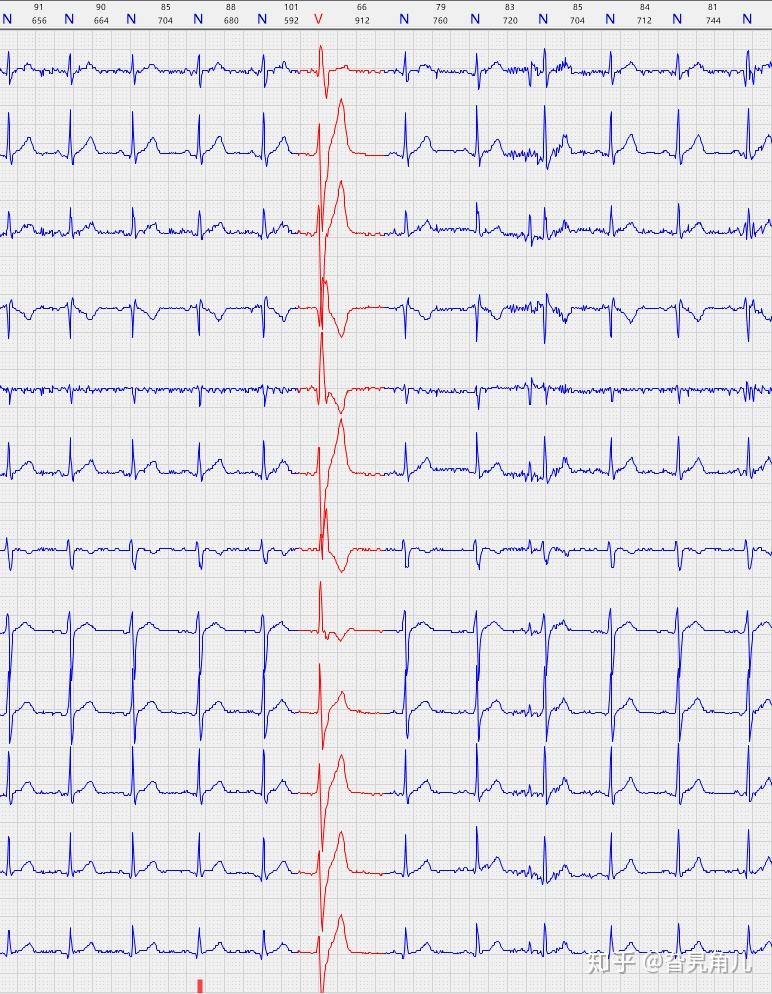 室上性早搏的心电图图片