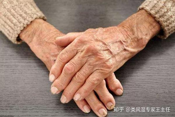 风湿如何治疗 zhuanlan.zhihu.com