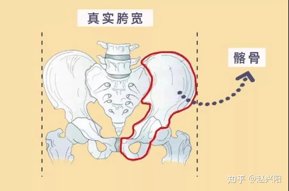 髂骨突出示意图图片