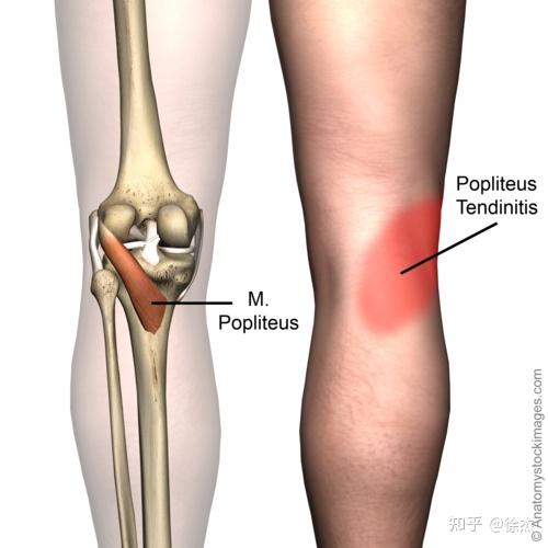 股内侧肌是一块水滴型的肌肉,它属于股四头肌,位于大腿内侧