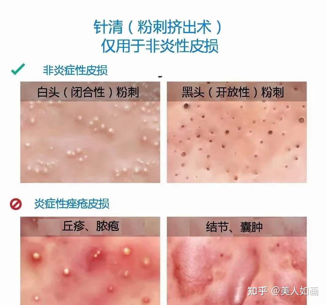 所有的痘痘都可以针清吗?那你适不适合呢? - 知乎