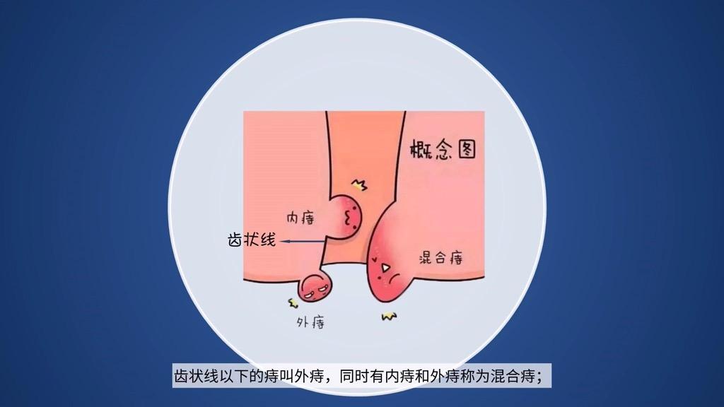 为什么越来越多的人会得痔疮