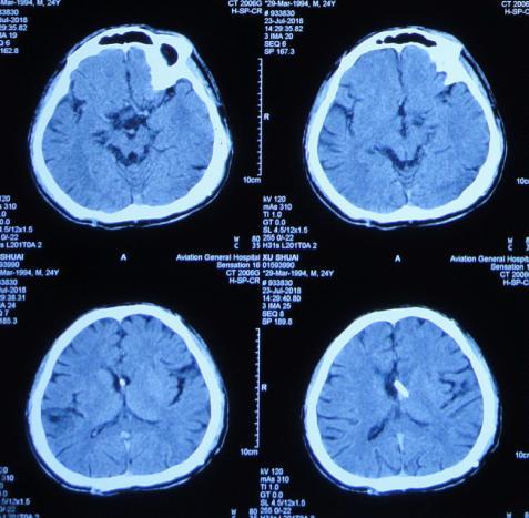 男子腦畸胎瘤術後腦積水18年內3次腦室腹腔分流術和3次調整分流泵壓後