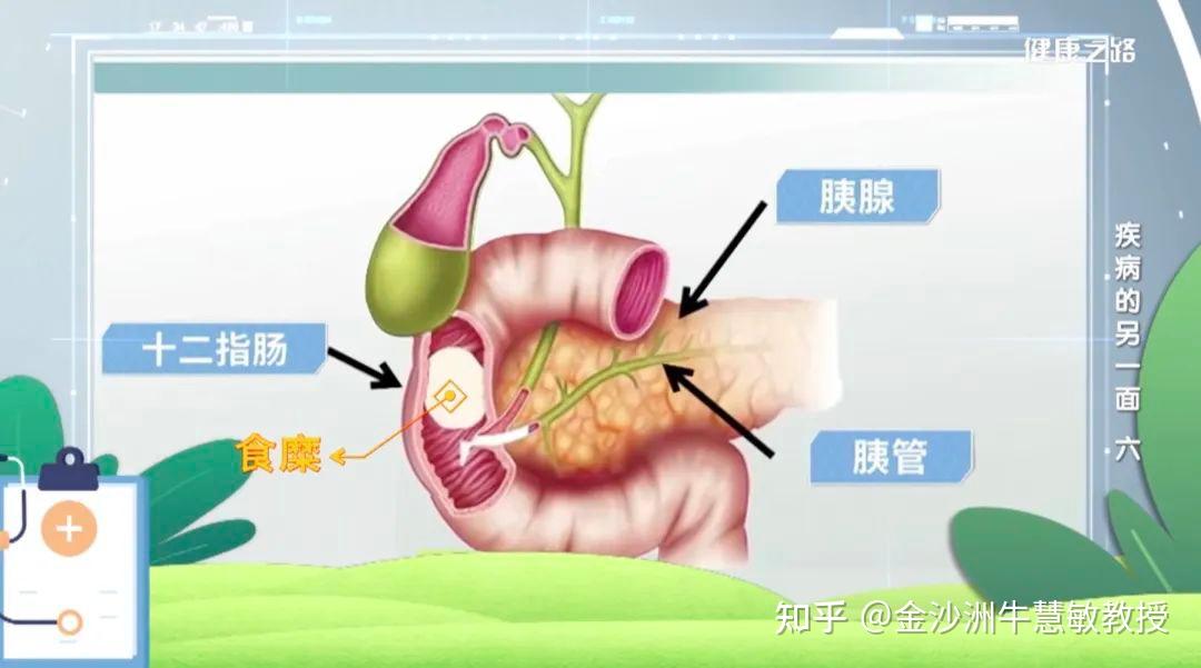 胰腺癌是最“内向”的癌,也是最沉默的“杀手” - 知乎