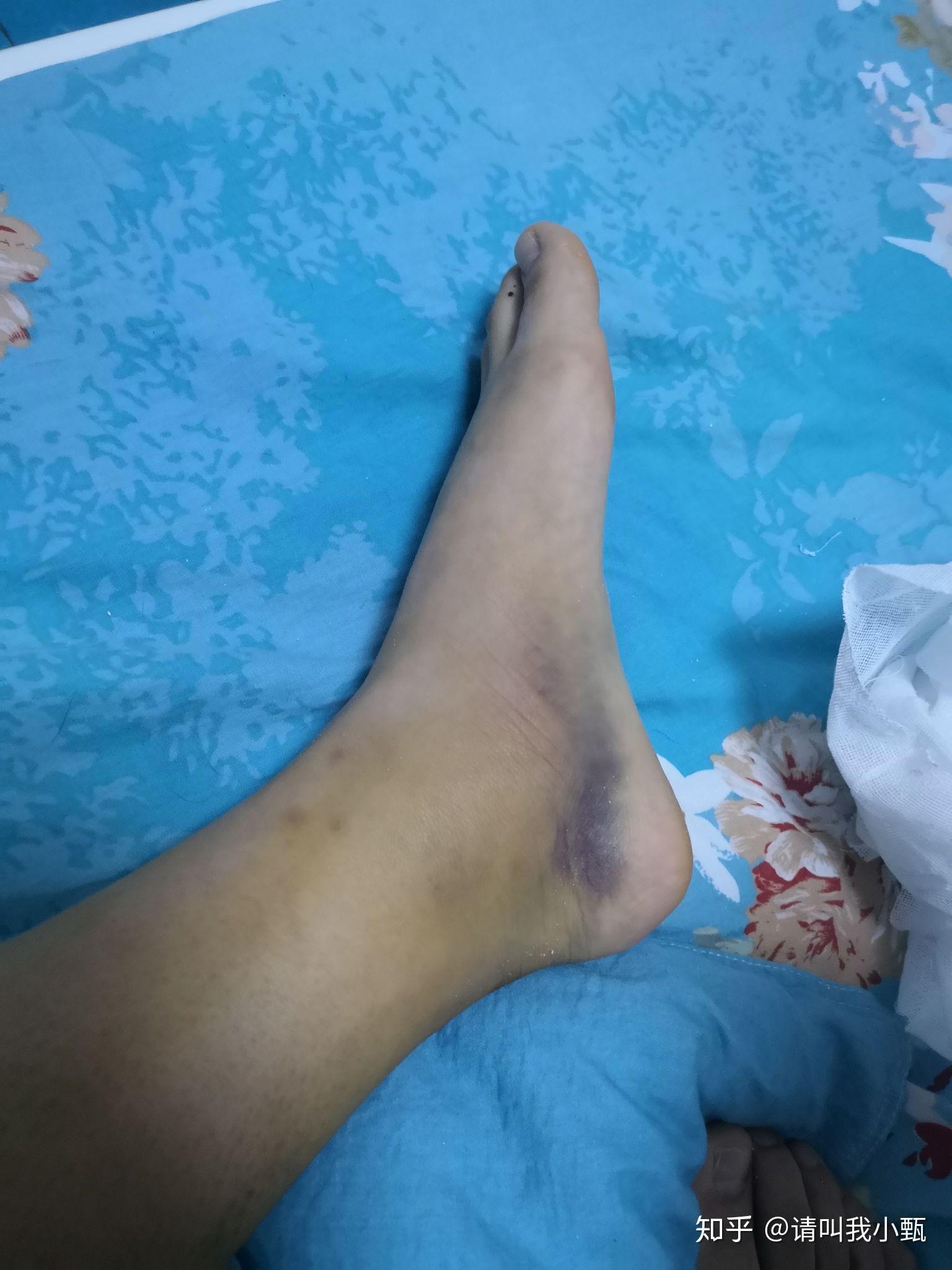 脚骨折的记录 - 知乎