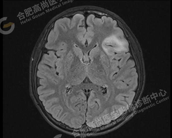 病例科普:头颅MR诊断局灶性皮层发育不良(FCD) - 知乎