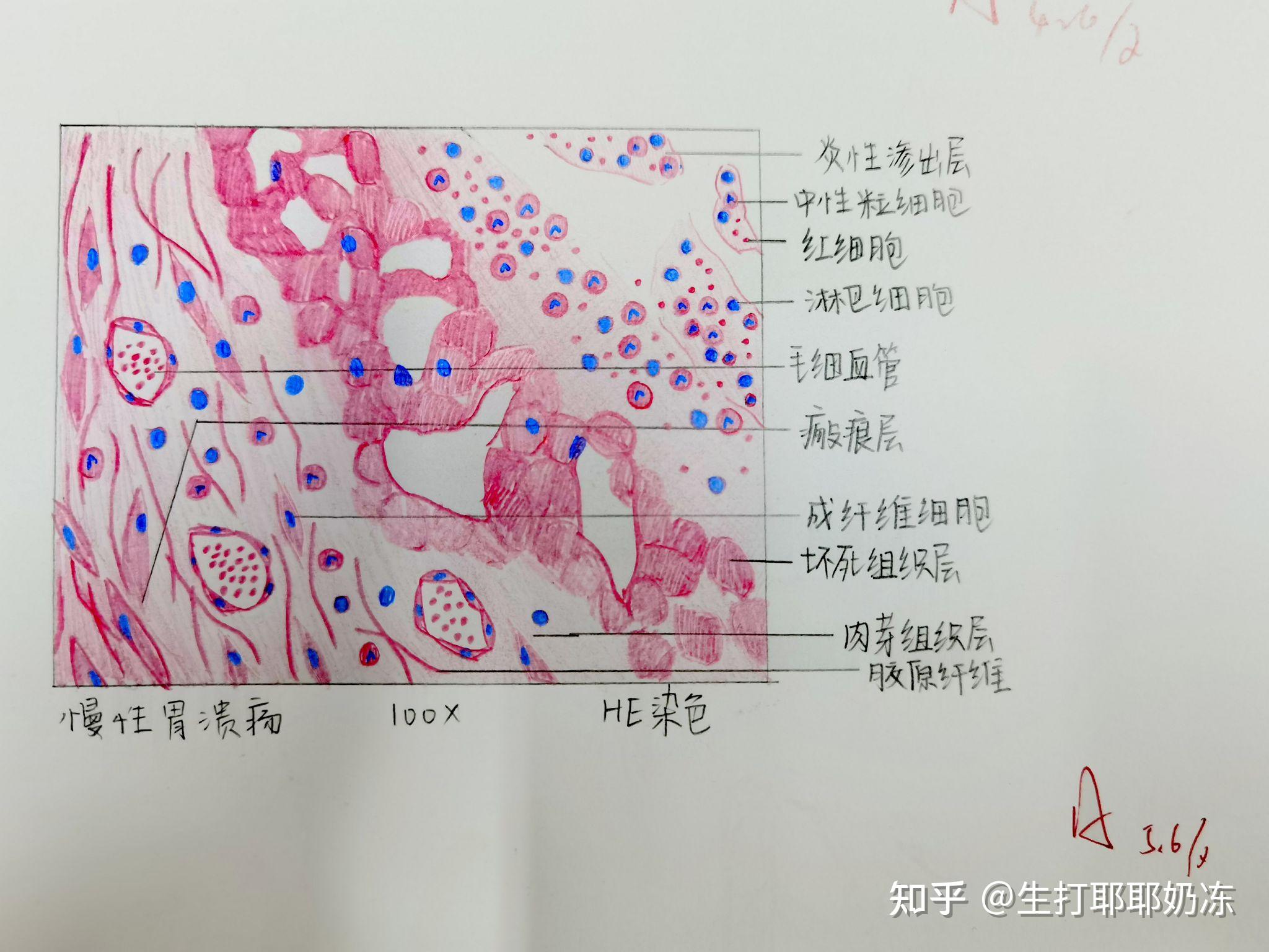 皮肤乳头状瘤红蓝绘图图片