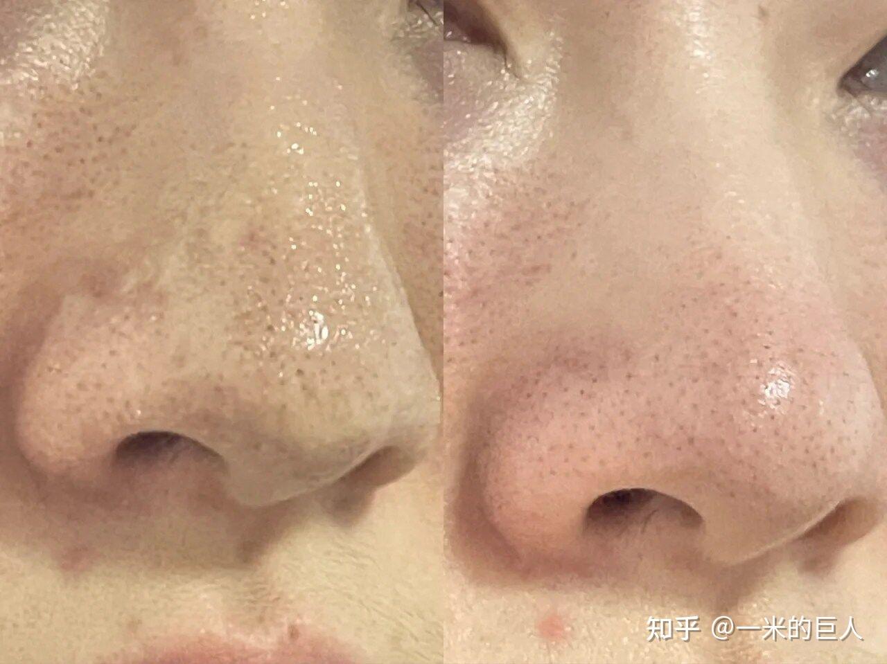 如果你脸上天天冒油,鼻子上黑头扎堆,又大又硬,用了很多方法都没办法,可以看看我的经历(非盈利回答) - 知乎