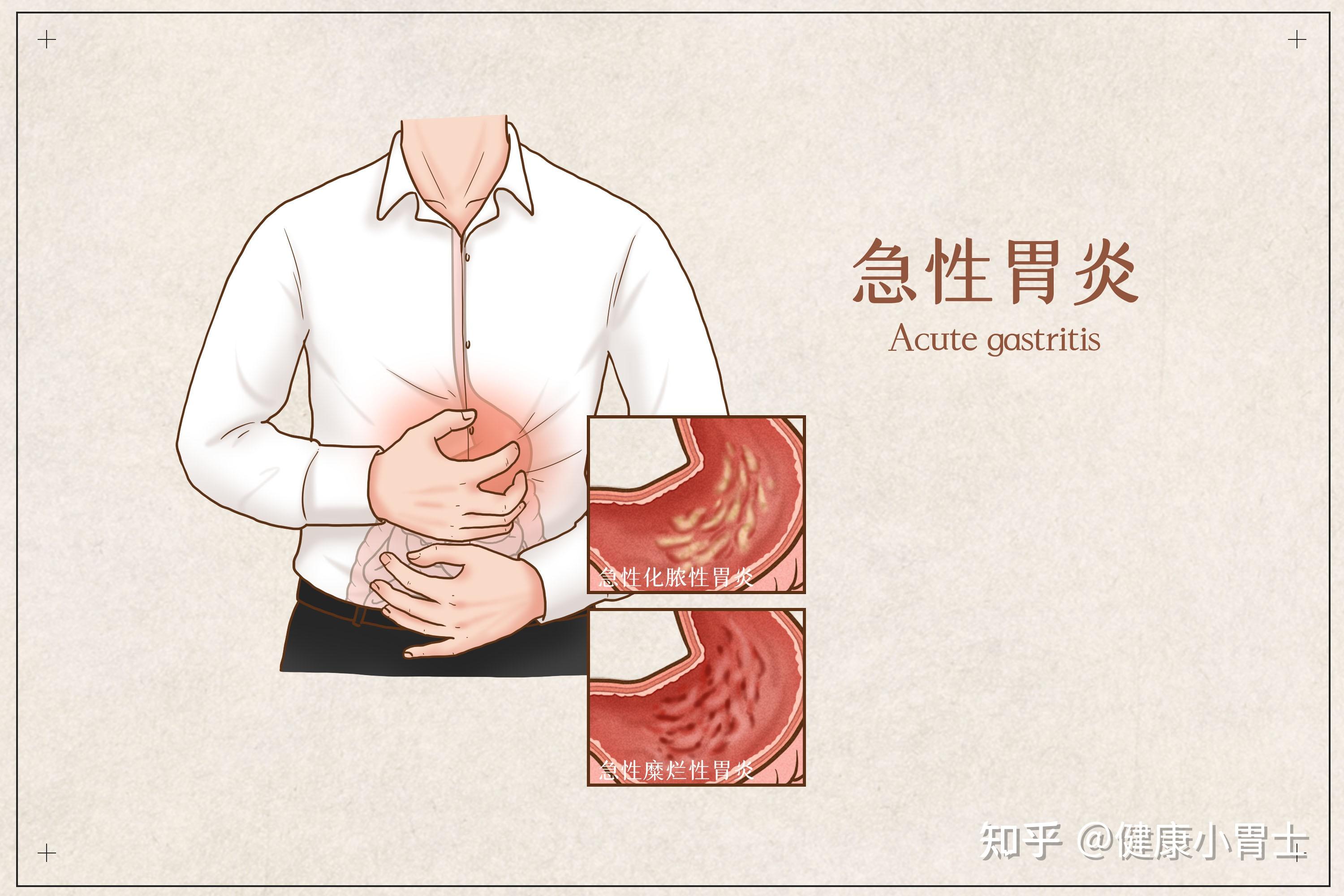 大圣胶囊胃镜:胃炎到胃癌只有4步,学好这4招逆转乾坤!