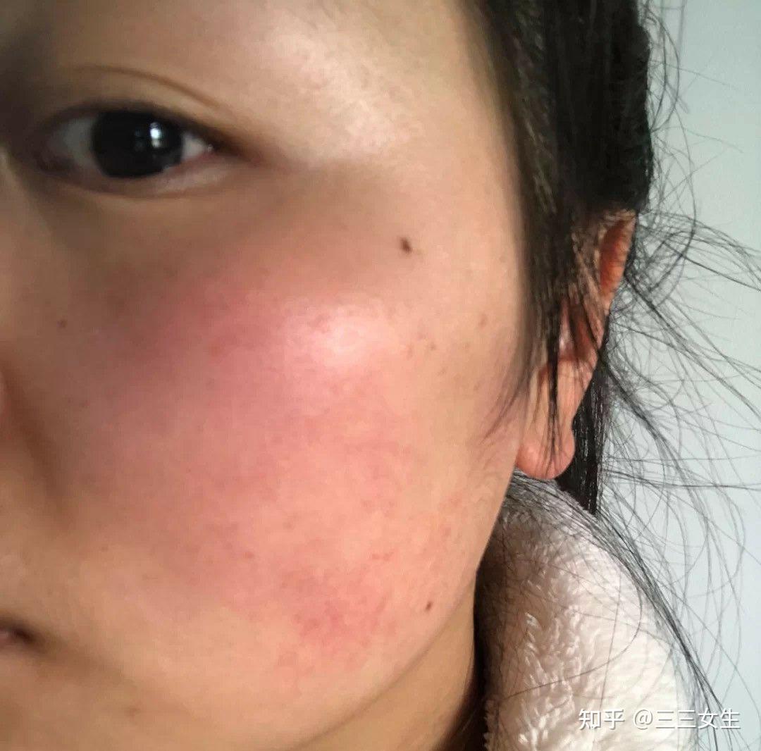 角质层薄有红血丝皮肤可以自己修复吗