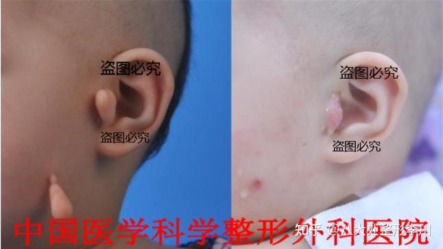 【小耳畸形诊疗指南01】先天性附耳屏-多耳畸形如何治疗?
