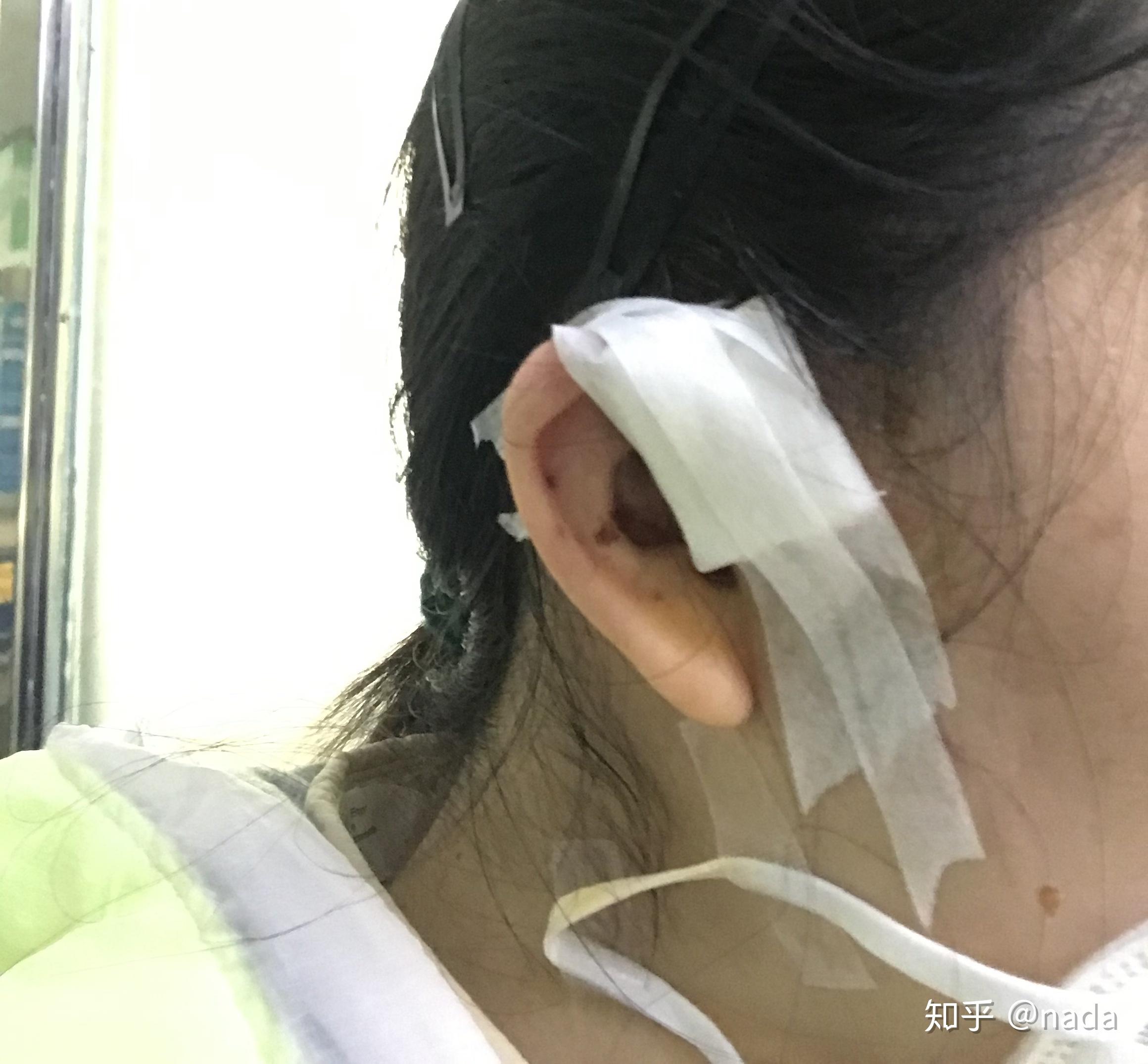 先天性耳前瘘管需要手术吗-京东健康
