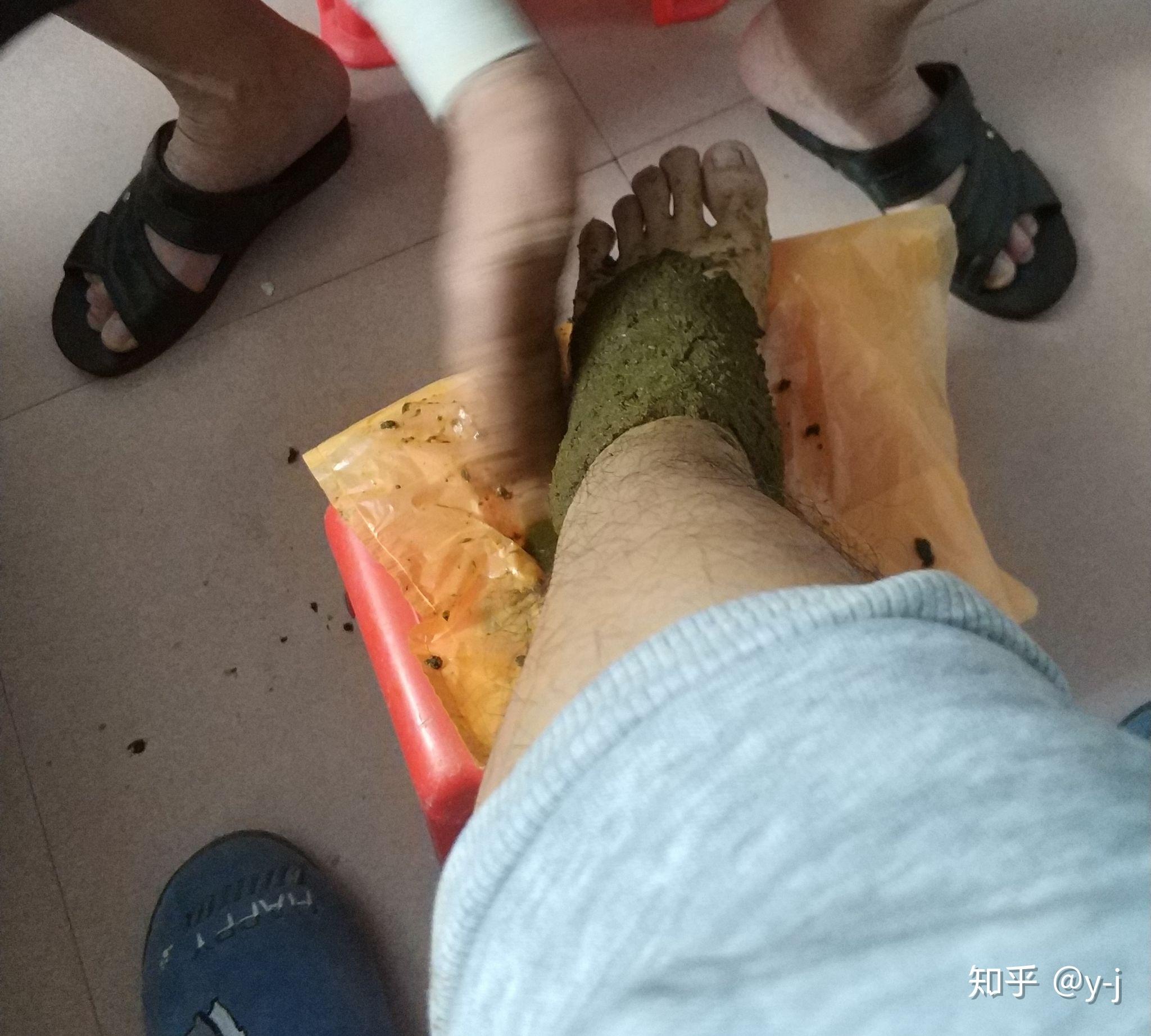 脚踝扭伤后如何的正确处理? 敷中药的效果如何?