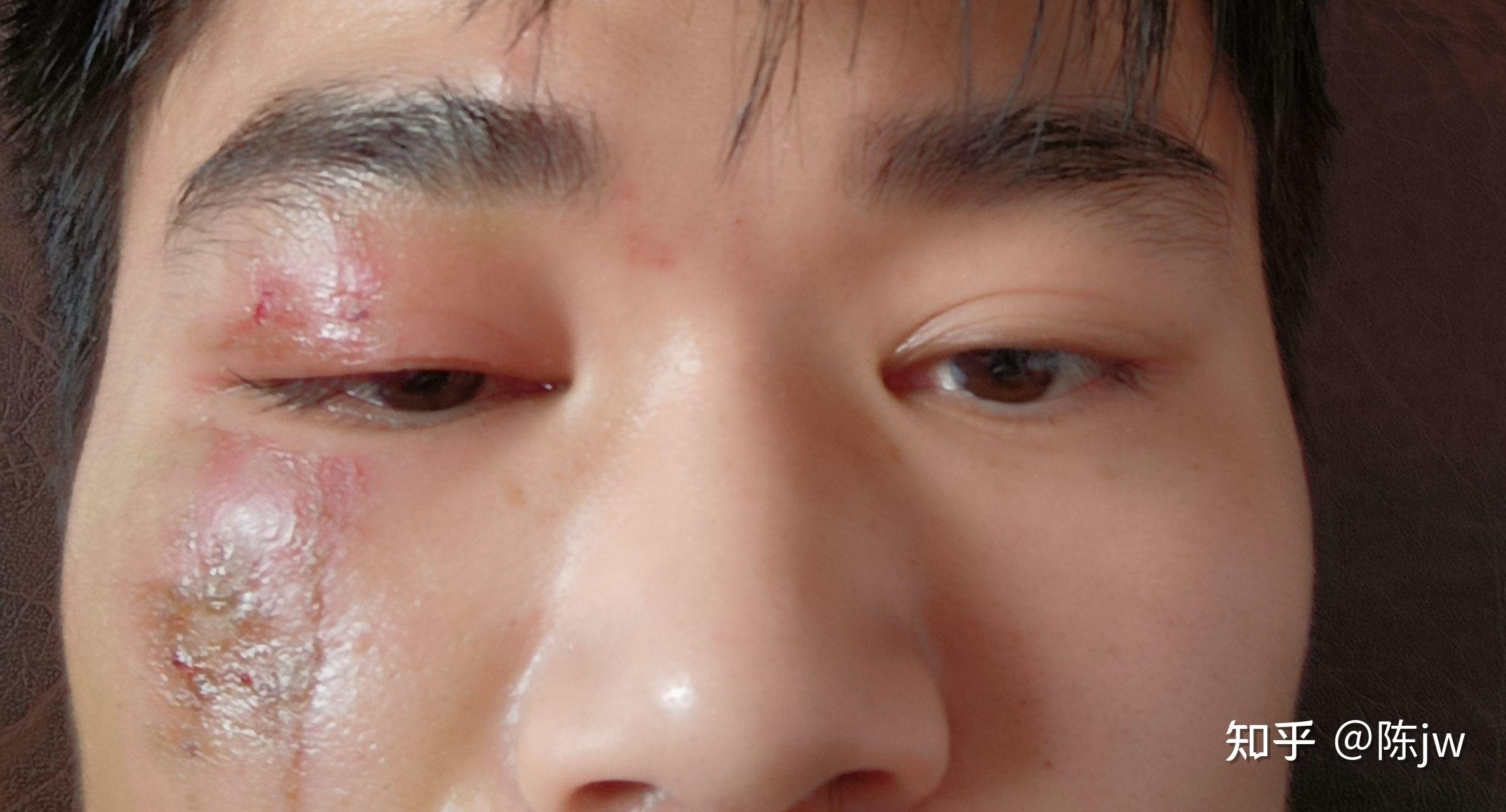 记一次脸部隐翅虫皮炎