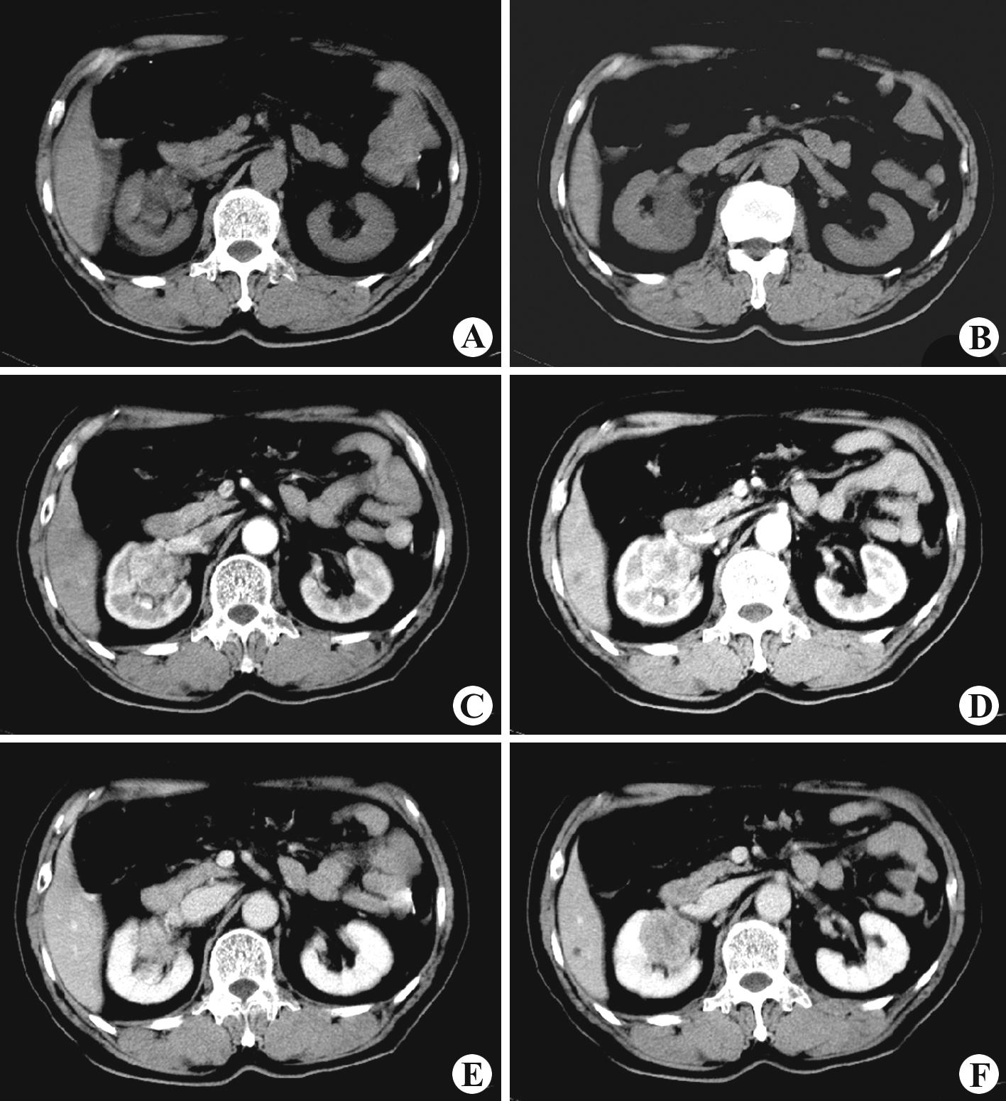 f)呈低密度,低于正常肾实质,显示更加清楚图6-129:右肾盂癌ctct平扫