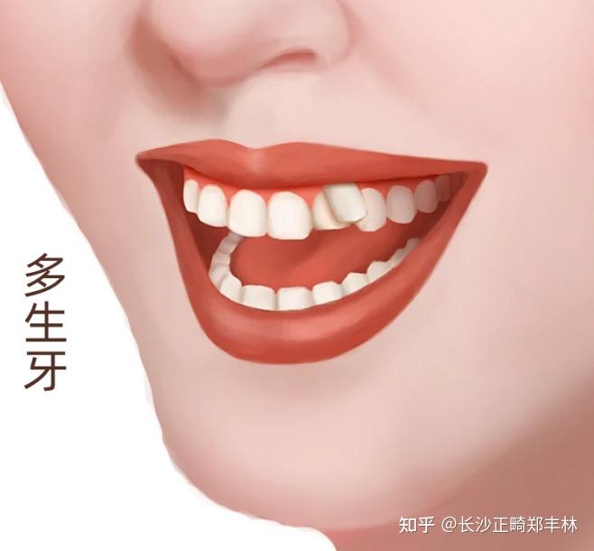 为什么会长多生齿？ - 知乎