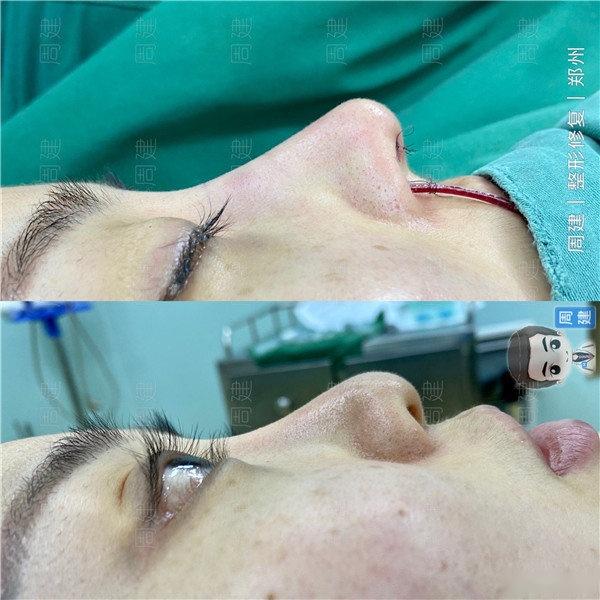 郑州鼻修复整形专家周建为避免多次鼻整形修复先看看常出现的问题