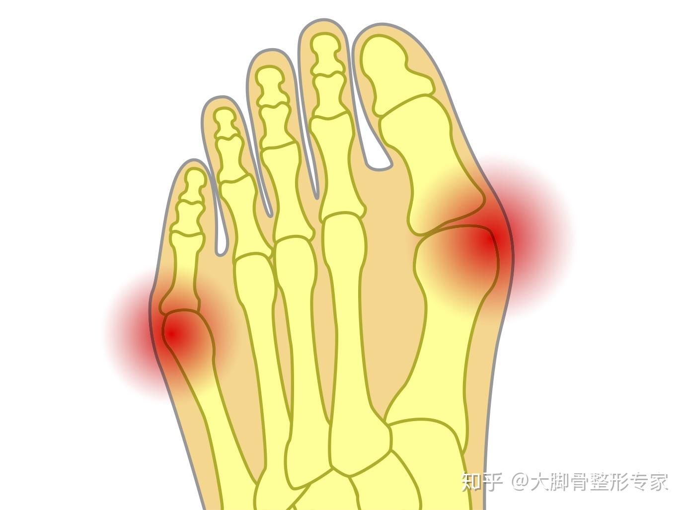 甚至出现半脱位等情况,由于跖骨向内侧偏斜,第一跖骨头偏离了位置