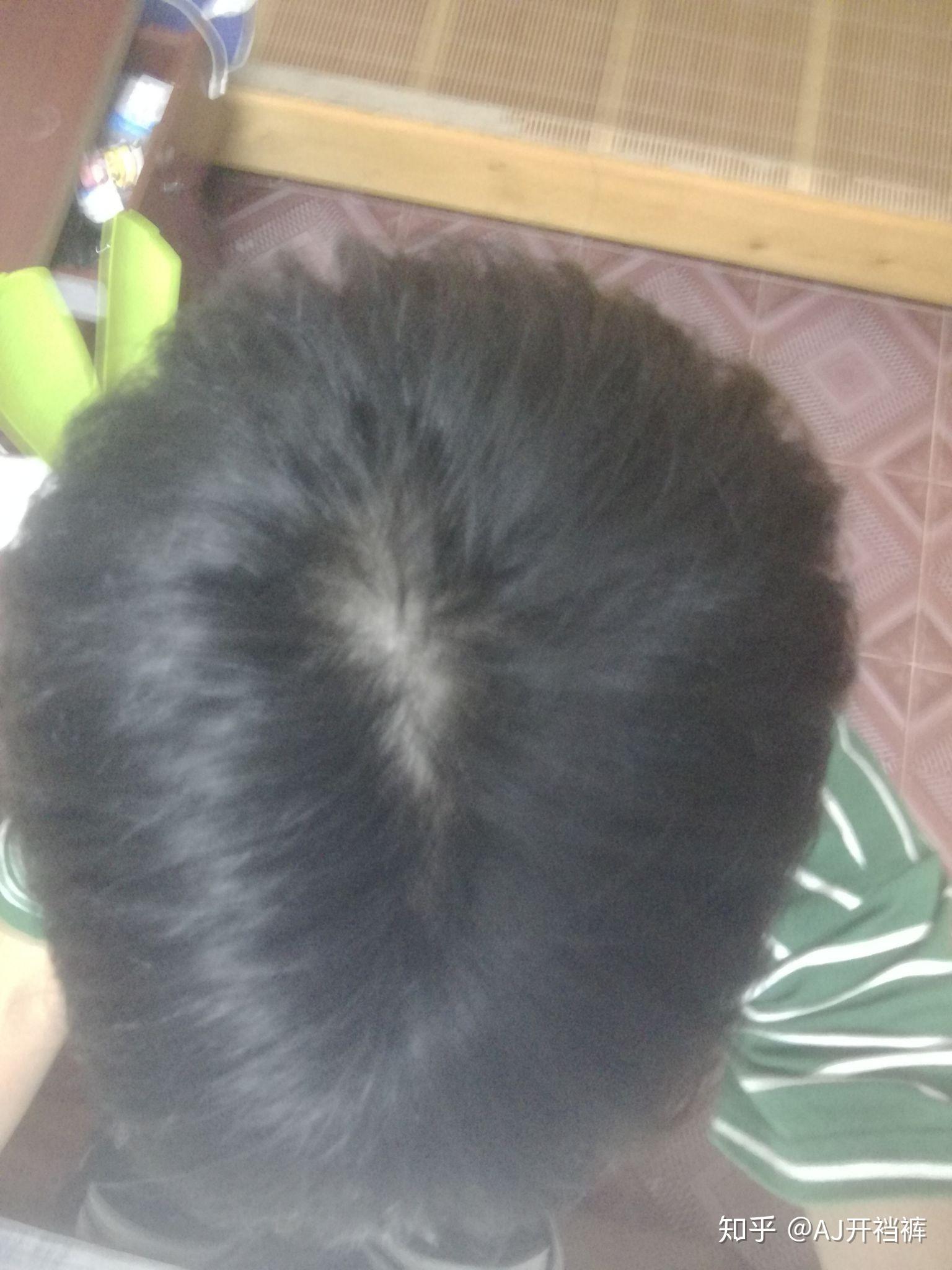 发旋处头发少怎么办？ - 知乎
