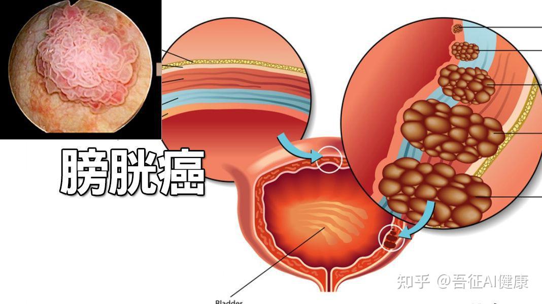 膀胱破裂图片