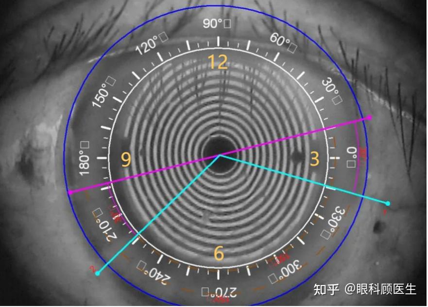 角膜子午线图片