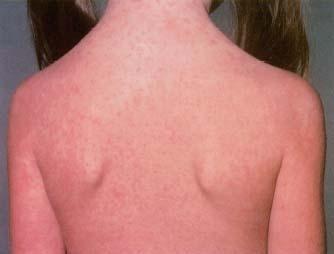 风疹病毒igm抗体检测试剂说明书