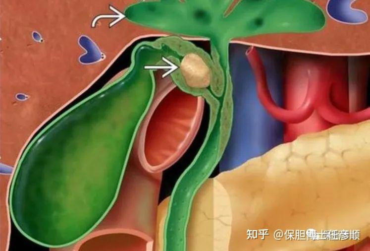 什么是mirizzi综合征?谈胆囊结石嵌顿的危害