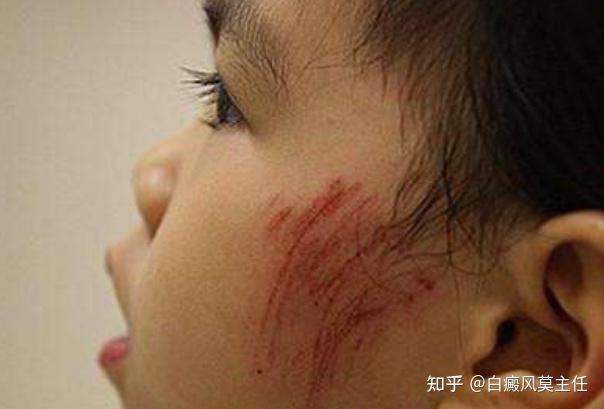 伤口周围突然变白?伤口愈合后,警惕创伤型白斑! - 知乎