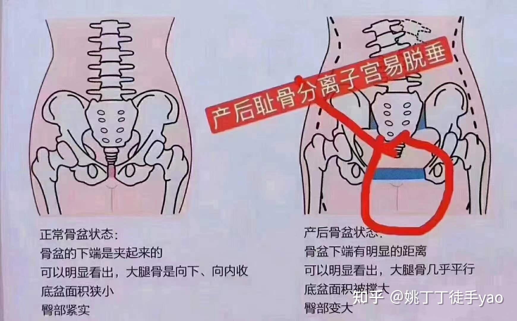 如何選擇修復骨盆的方法初出茅廬的母親必須知道