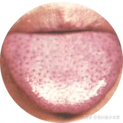 为什么老中医都要看你的舌苔,史上最全舌苔看病大全 - 知乎