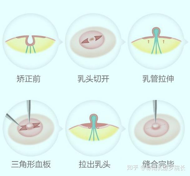 非手术手法牵引:第一,用拇指(或食指)平行放在乳头两侧,慢慢地由乳头