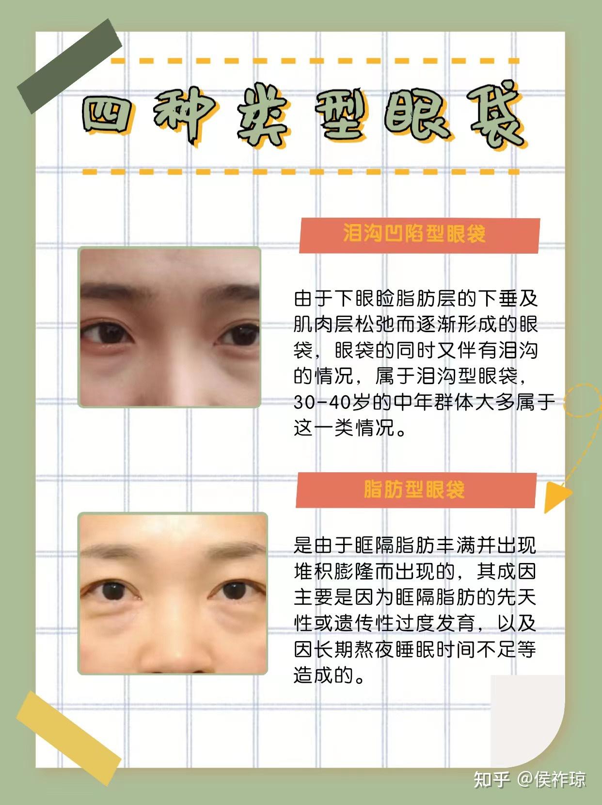 眼袋分哪几种类型