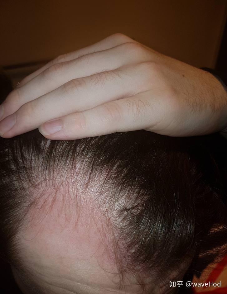 微针生发经验6单用滚针3个月效果图片2018全年更新