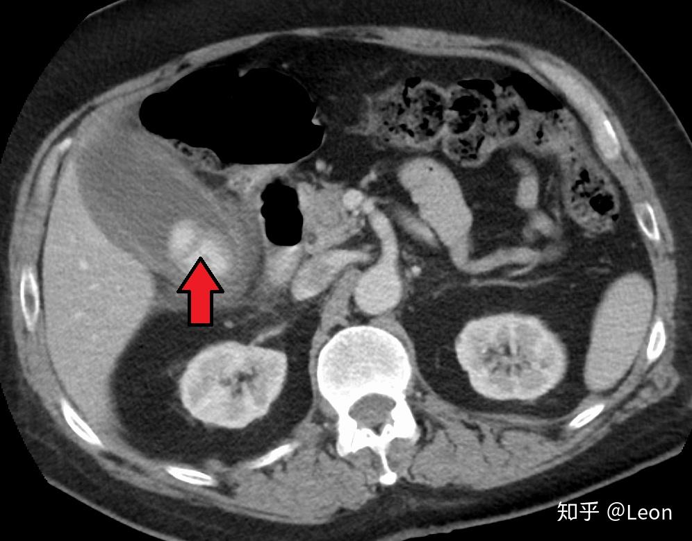 膽囊炎cholecystitis