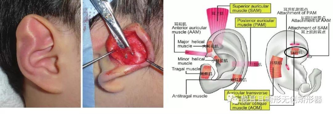 常見的垂耳畸形是由於耳後斜肌消失,耳橫肌延長導致,圖中右側畫圈部分