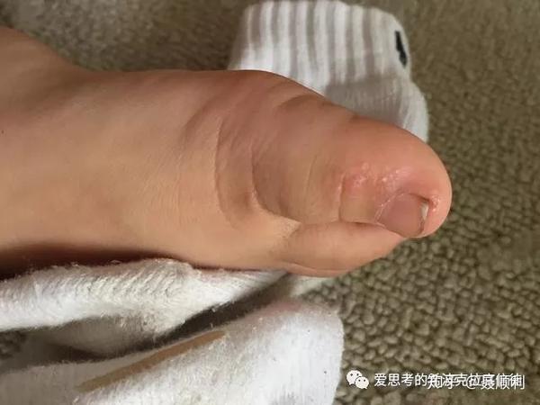 儿童的皮肌炎多发性肌炎的诊断与鉴别诊断上