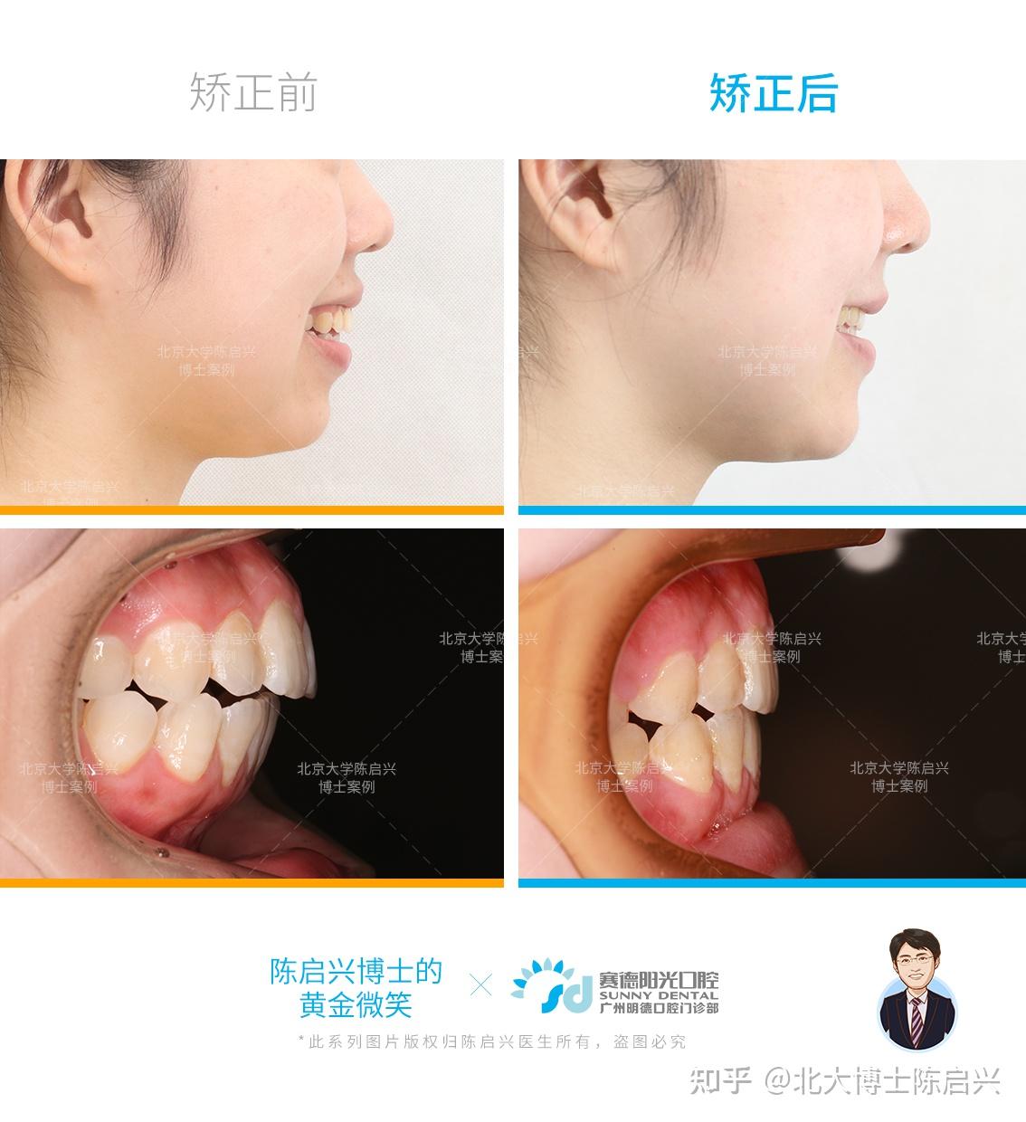 舌侧矫正骨性二类高角 上颌前突 下颌后缩 开颌案例