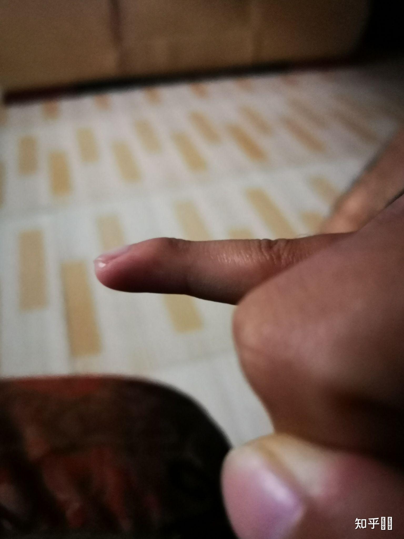 小拇指末端肿大?两个小拇指都是这样,右手更严重.